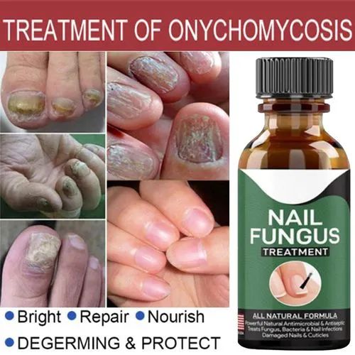 Nail Fungal Treatments Nail Repair Essences Serum 10ml