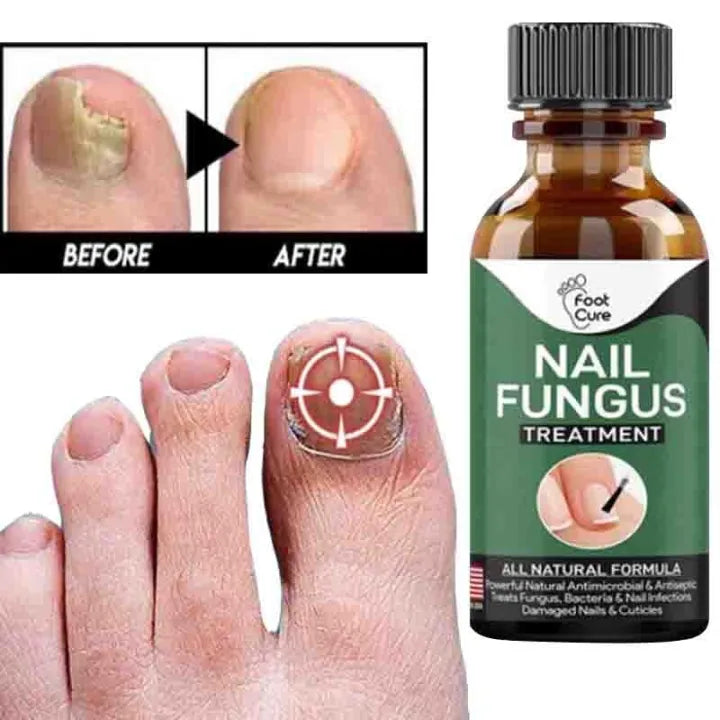 Nail Fungal Treatments Nail Repair Essences Serum 10ml